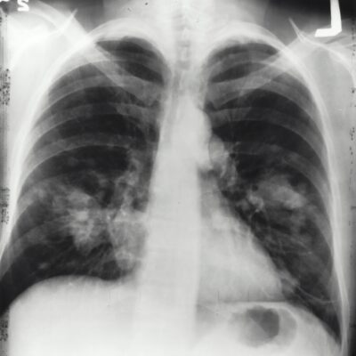 Lung Cancer