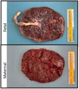 Images of the fetal and maternal surfaces of the placenta