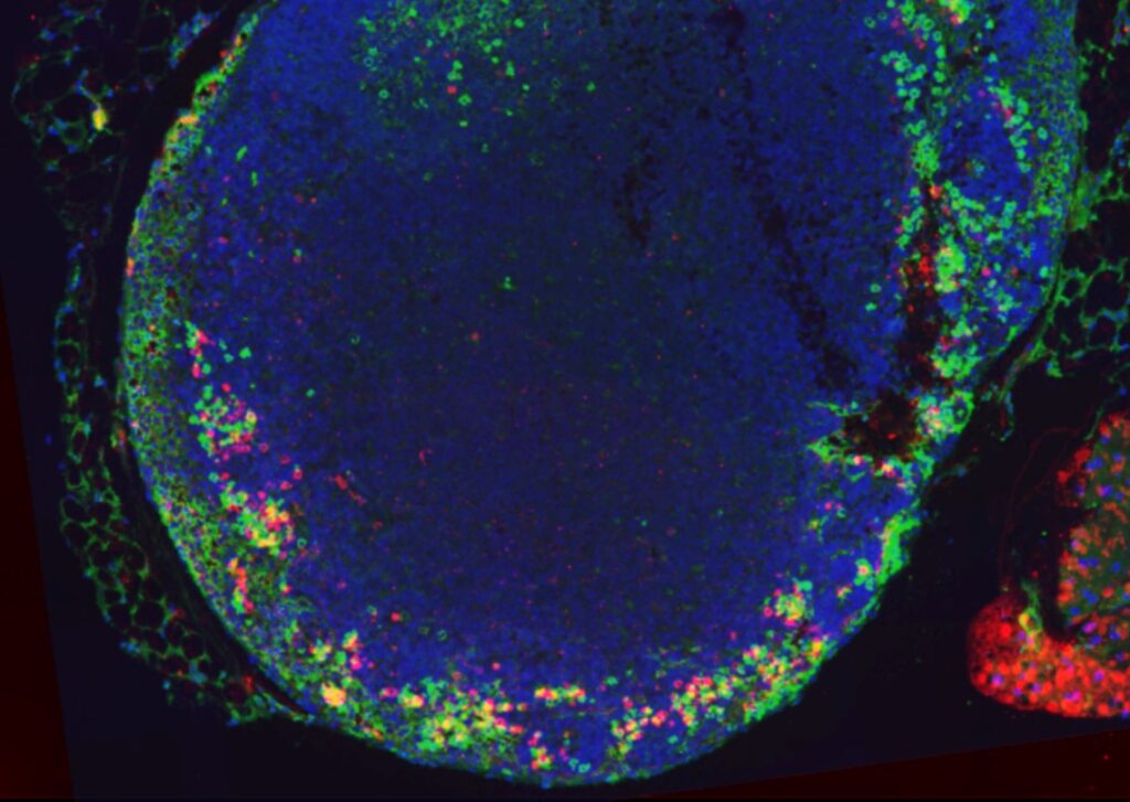 An advanced-stage tumor after 8 weeks, showing specific areas where cancer-spreading leader cells (KRT14+ LCs) and immune-suppressing cells (Tregs) are concentrated, driving tumor growth and immune evasion