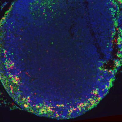 An advanced-stage tumor after 8 weeks, showing specific areas where cancer-spreading leader cells (KRT14+ LCs) and immune-suppressing cells (Tregs) are concentrated, driving tumor growth and immune evasion