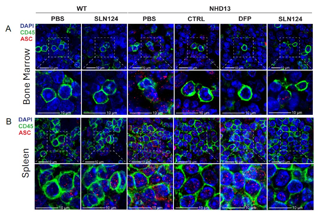 Images of bone marrow (A) and spleen (B) tissue showing that iron-reducing treatment decreased ASC specks, a marker of inflammation, in MDS compared with untreated controls